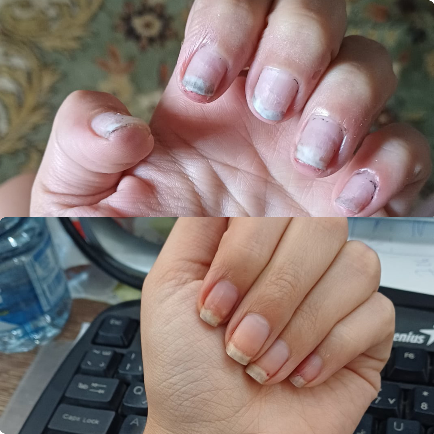 Intensive Fungal Nail Recovery Ritual