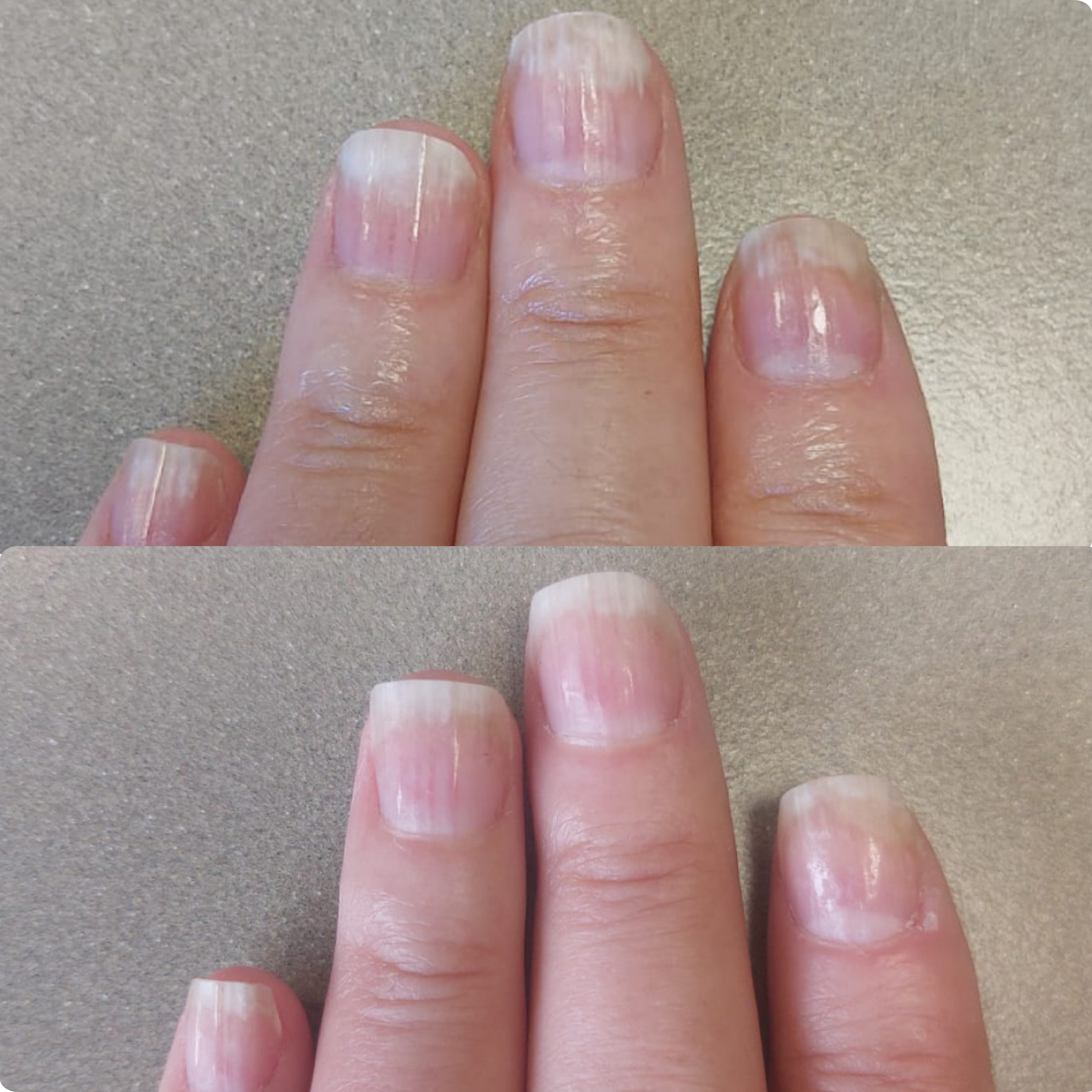 Nail Support Set - For psoriasis-affected or sensitive nails