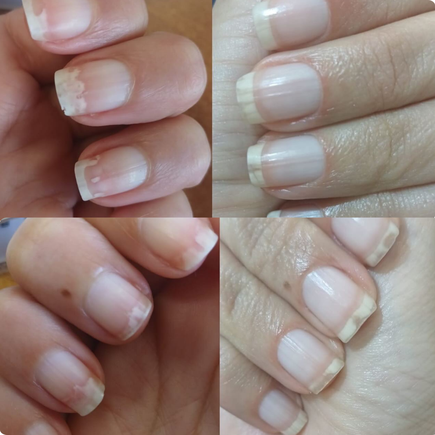Intensive Fungal Nail Recovery Ritual