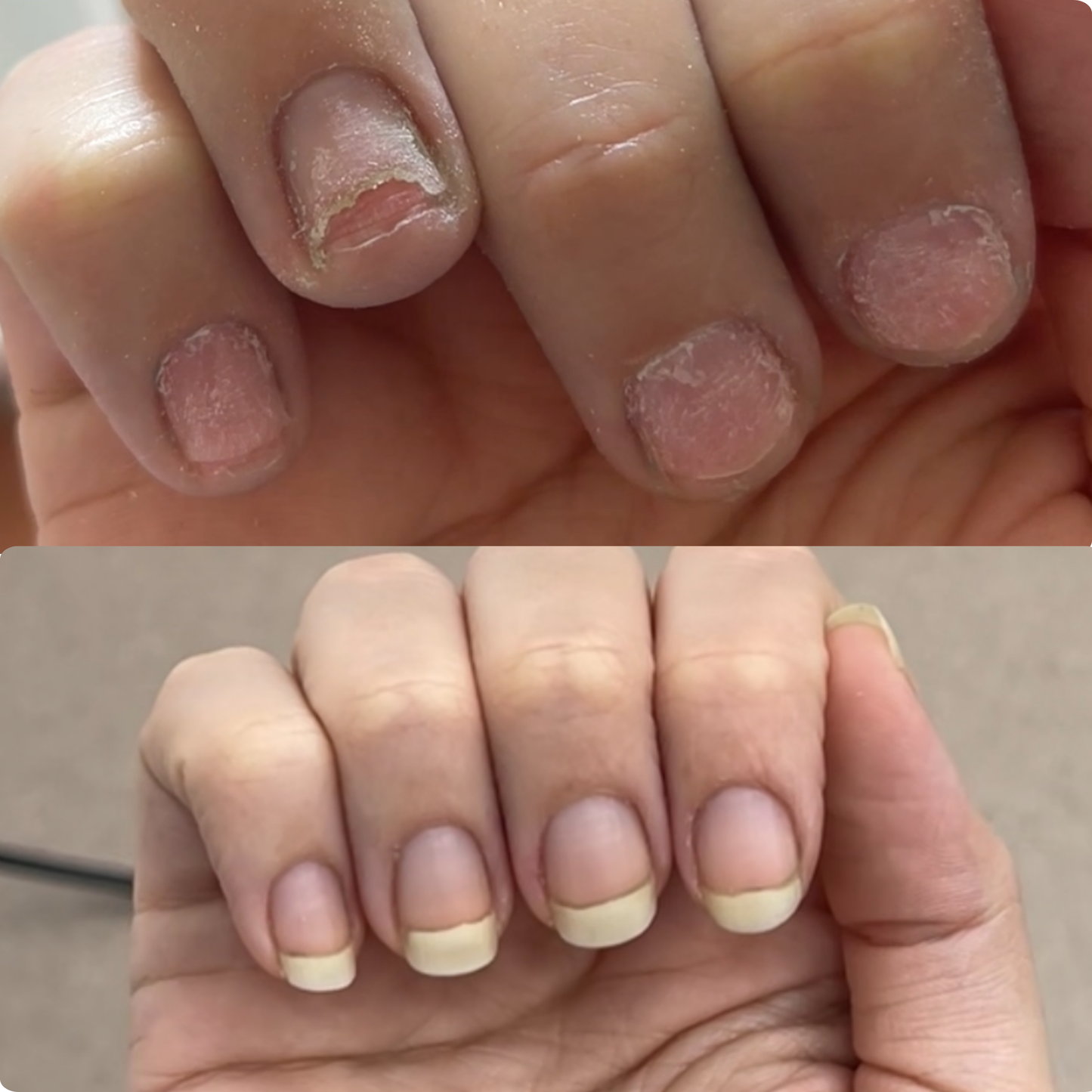 Intensive Fungal Nail Recovery Ritual