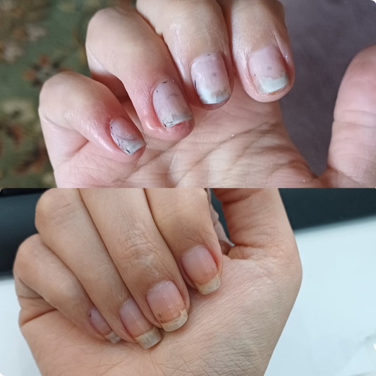 Intensive Fungal Nail Recovery Ritual