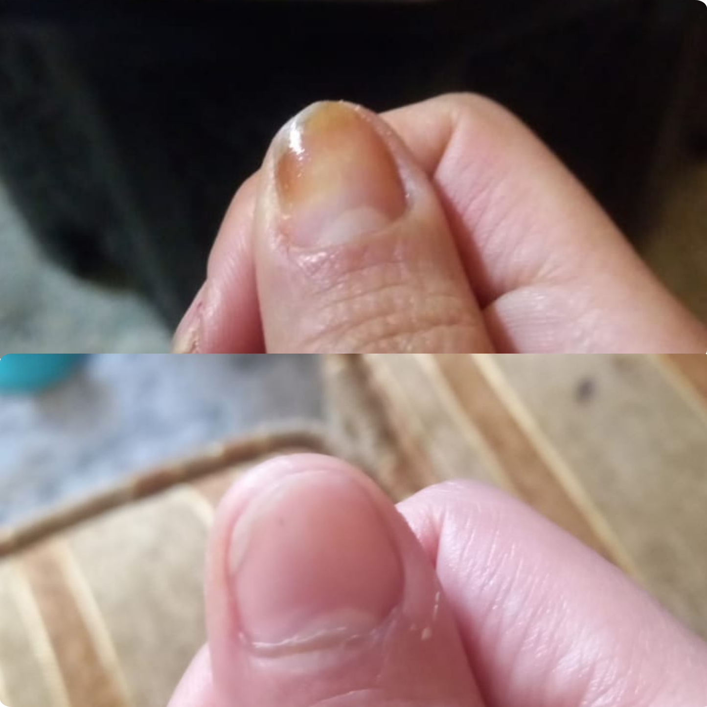 Intensive Fungal Nail Recovery Ritual