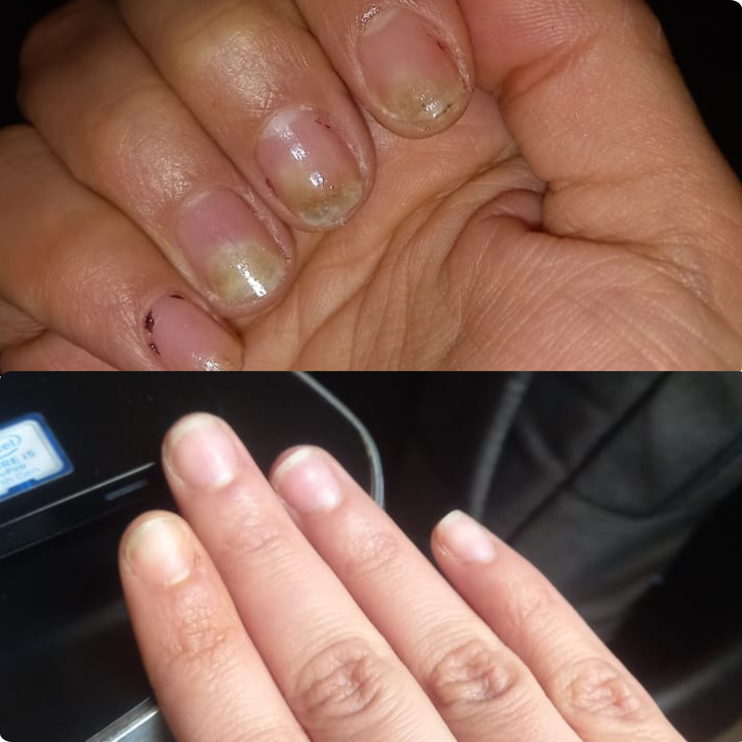 Intensive Fungal Nail Recovery Ritual