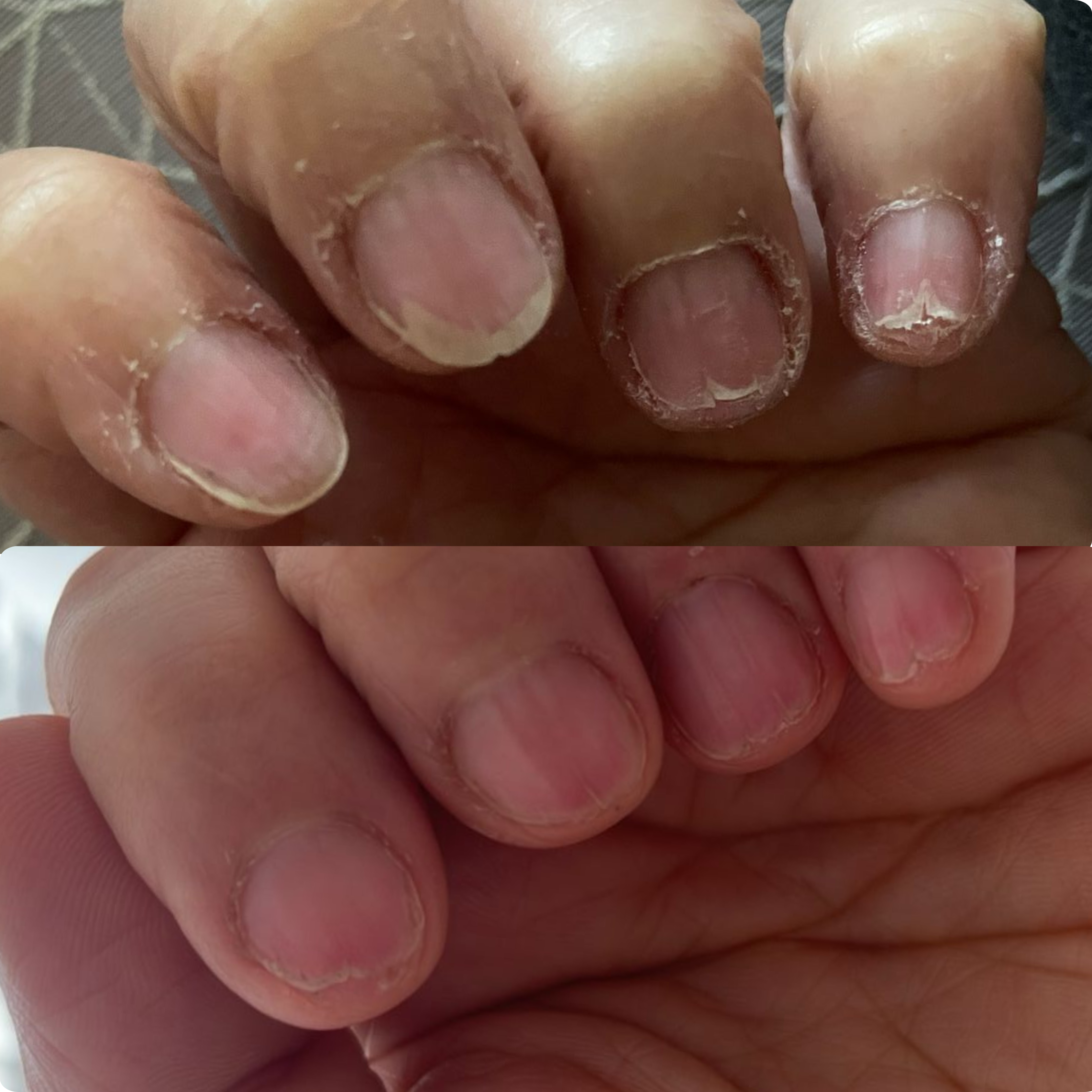 Nail Support Set - For nails weakened by medical treatments
