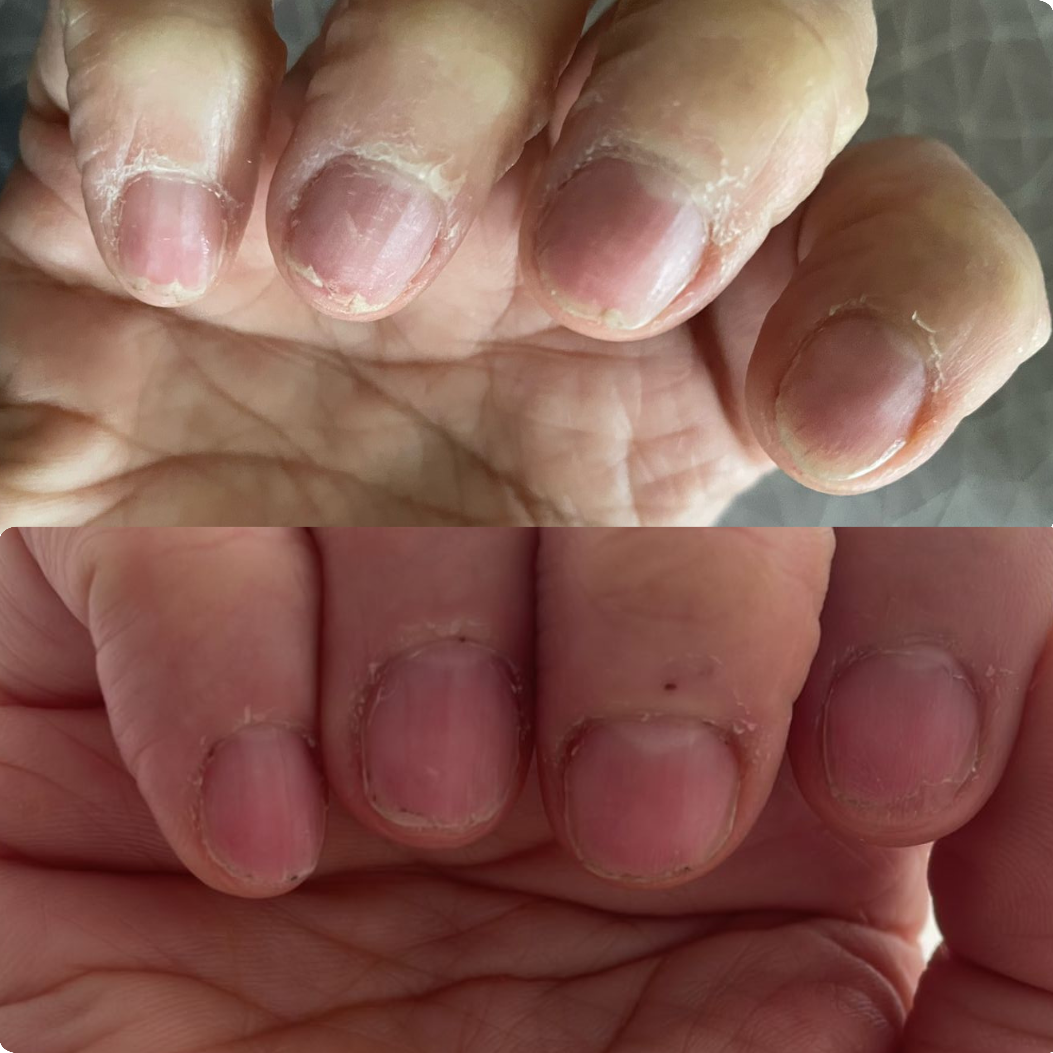 Nail Support Set - For nails weakened by medical treatments